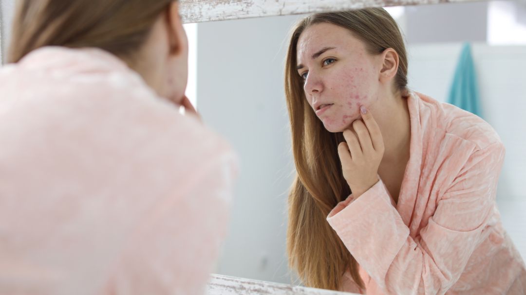 The Top 4 Causes of Recurring Acne Breakouts